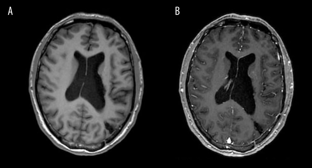 (A) Postoperative MRI of the head with pre-contrast T1WI sequence. (B) Postoperative MRI of the head with post-contrast T1WI sequence showed no abnormal enhancement, demonstrating no residual or recurrent tumor. MRI – magnetic resonance imaging.