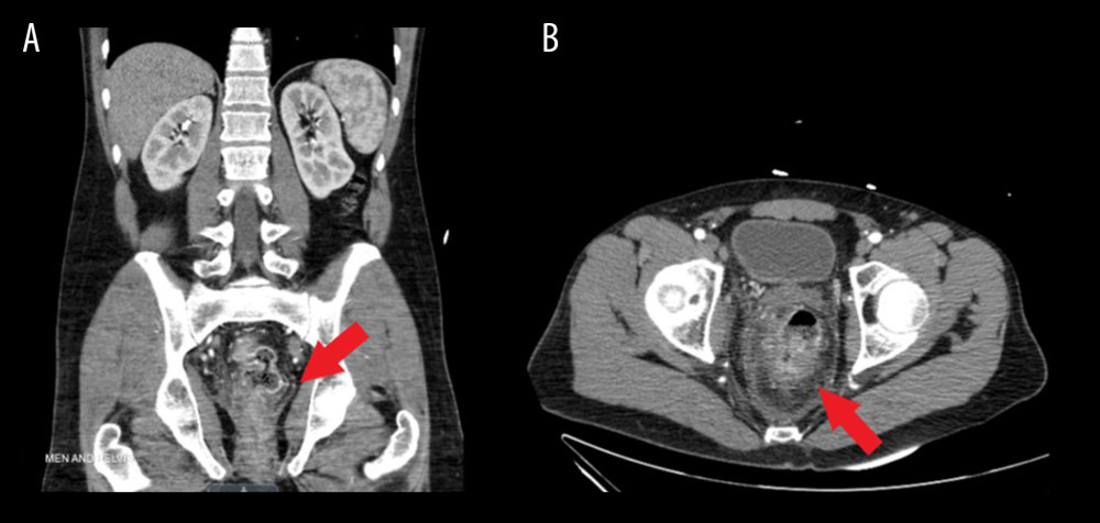(A) Coronal computed tomography (CT) displaying rectal inflammatory changes and edema as indicated by the red arrow. (B) Axial CT demonstrating peri-rectal inflammation and small abscess formation that can be seen with the red arrow.