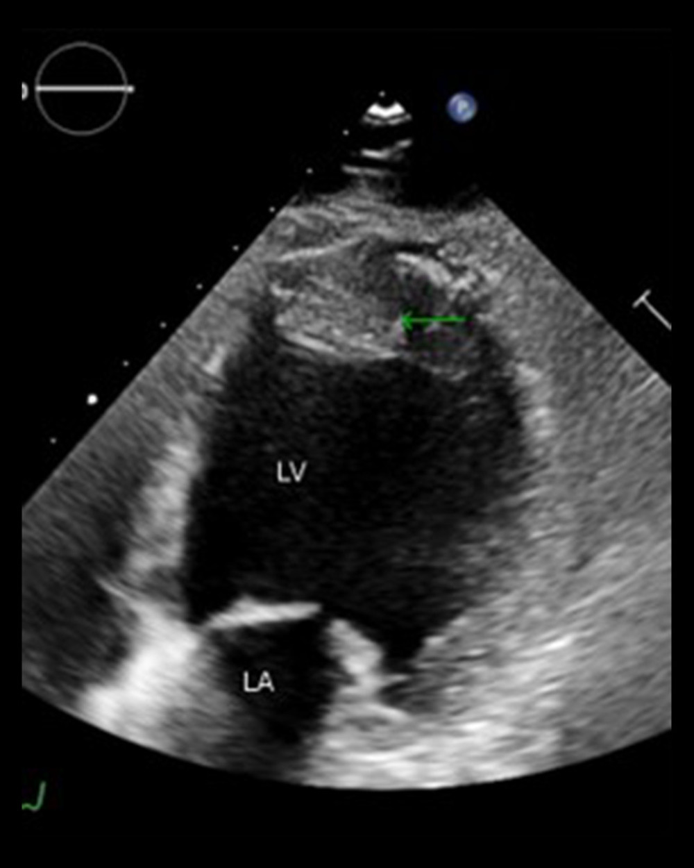 Echocardiography modified 4-chamber view showed large left ventricular apical thrombus in size of 20×15 mm (green arrow). LV – left ventricle; LA – left atrium.