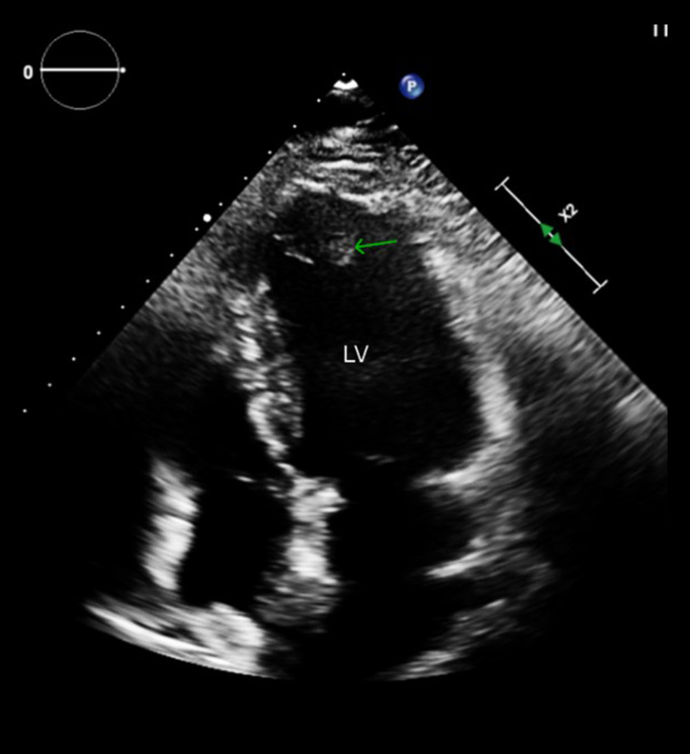 Echocardiography 4-chamber view showed persistence of left ventricular (LV) apical thrombus (green arrow).