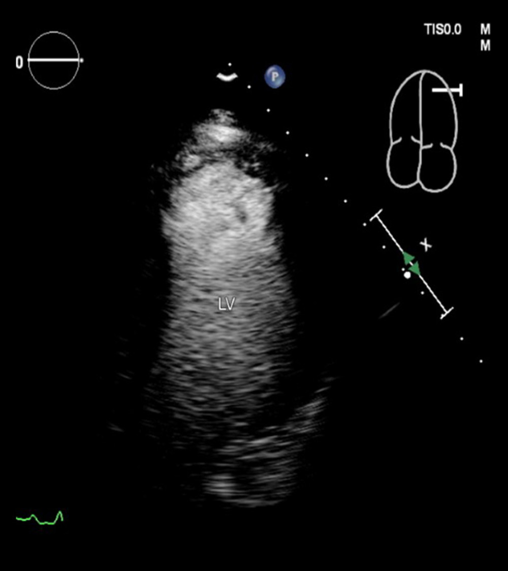 Contrast echocardiography 4-chamber view showing resolution of the apical thrombus. LV – left ventricle.