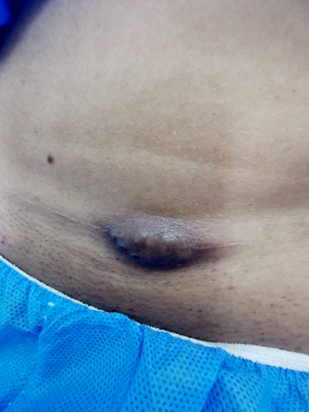 Photograph of the left corner of the cesarean section scar showing a bulging, hyperpigmented mass.