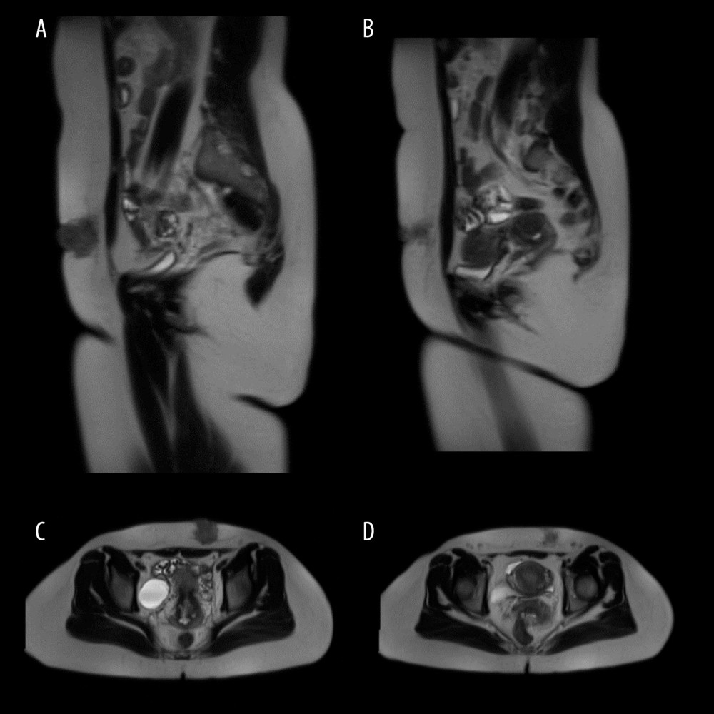 (A–D) Pelvic magnetic resonance imaging (MRI) scan showing a 3×3×3.5 cm left lower abdominal wall soft-tissue mass.