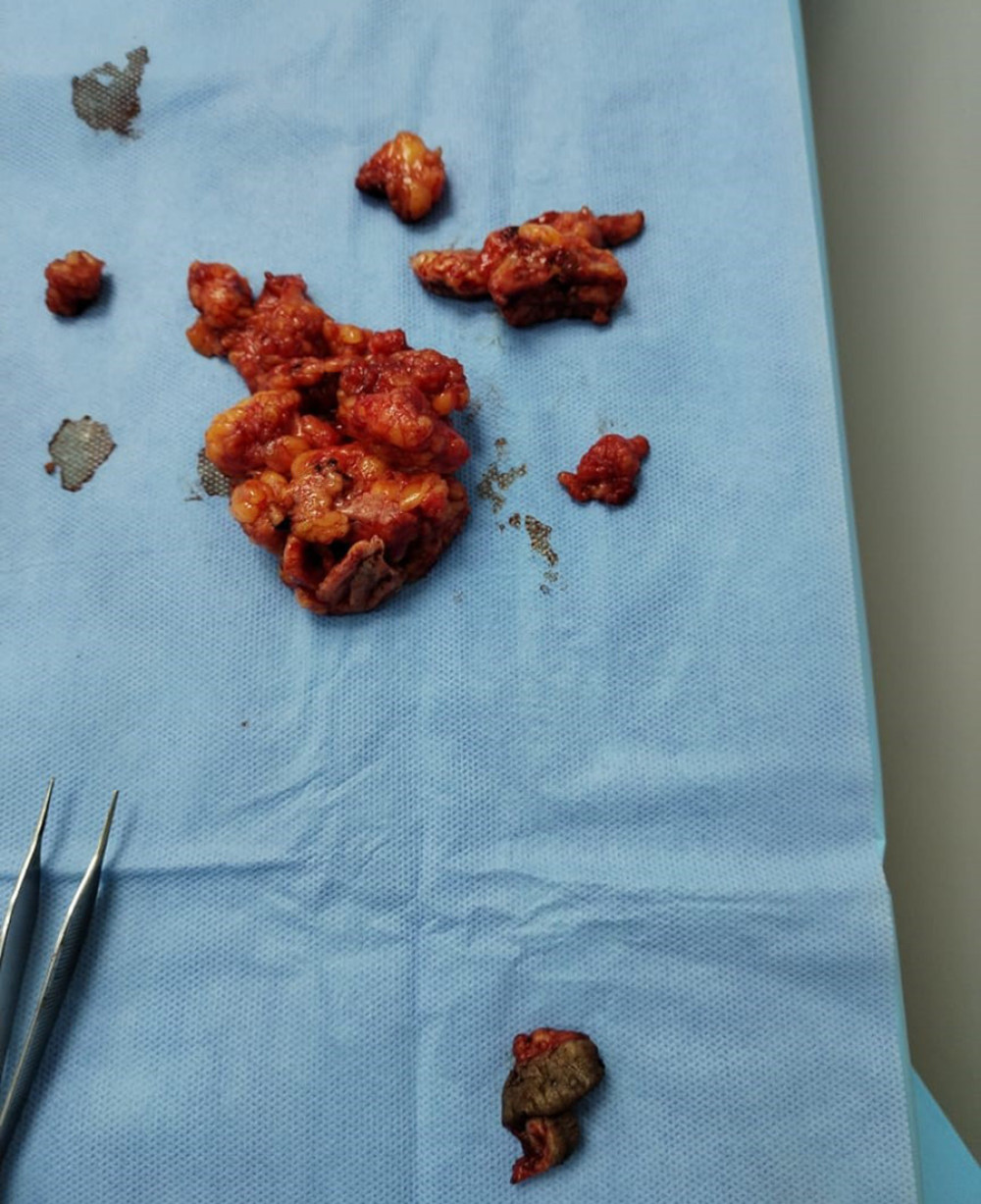 Photograph of the excised mass of the endometrioma.