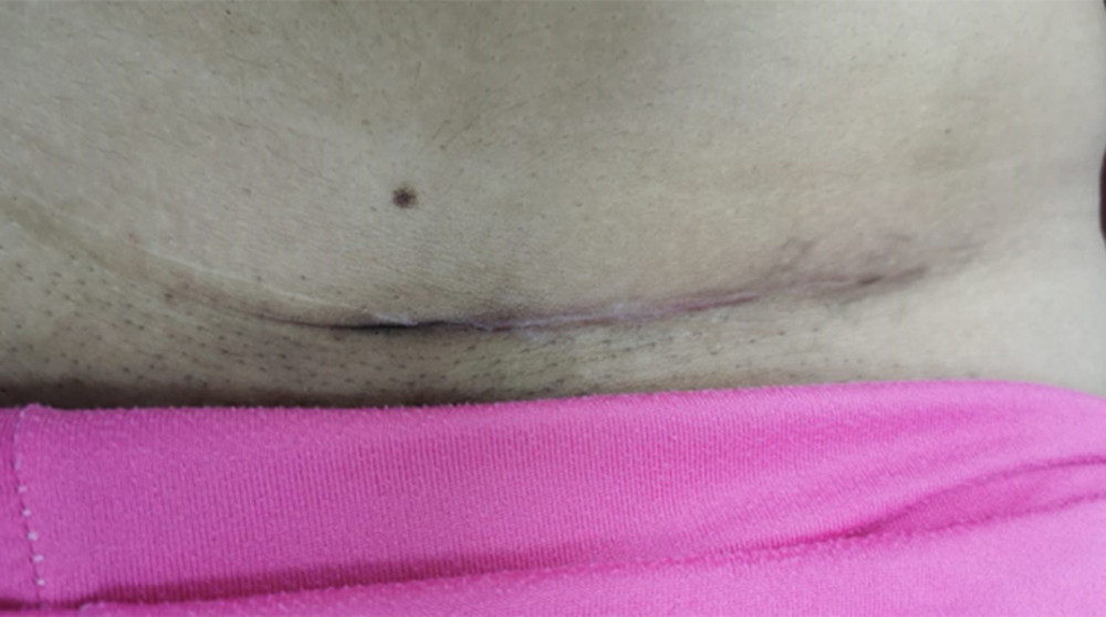 Photograph of the healed cesarean section scar after excision of the endometrioma.