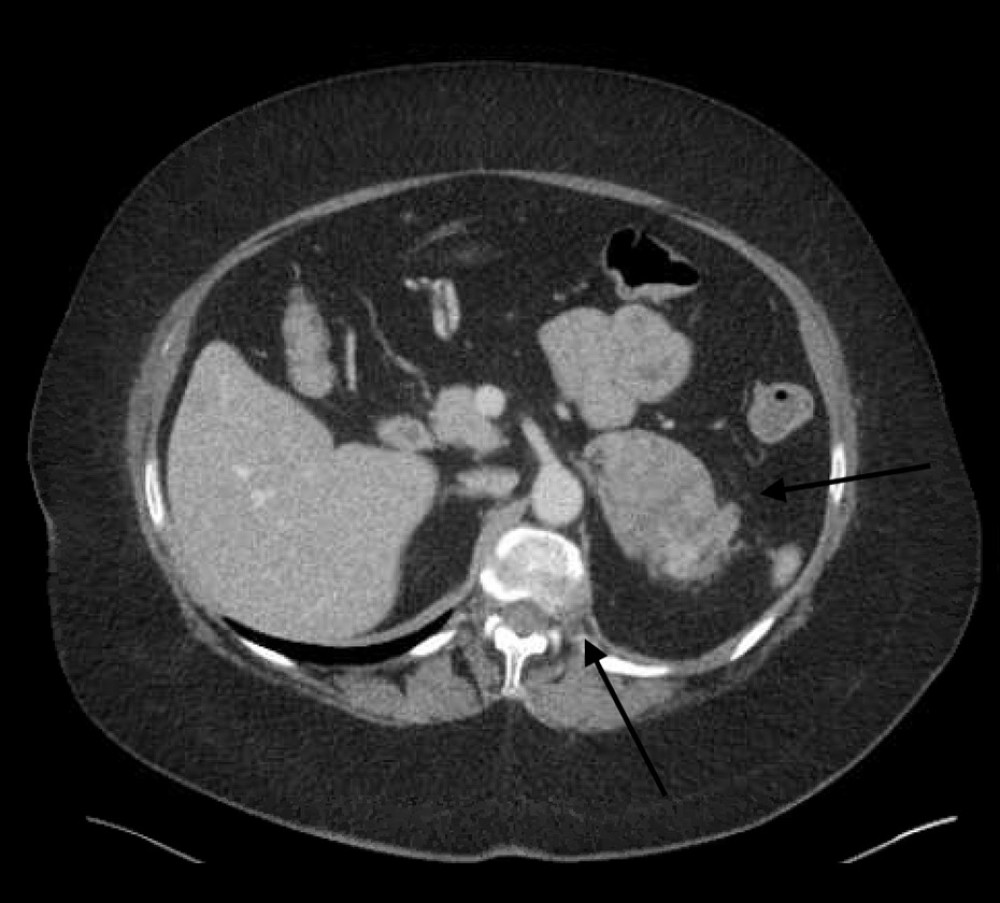 Contrast-enhanced CT imaging of the abdomen and pelvis revealing a left-sided adrenal mass (right arrow) and T12 level spinal destructive lesion (left arrow).