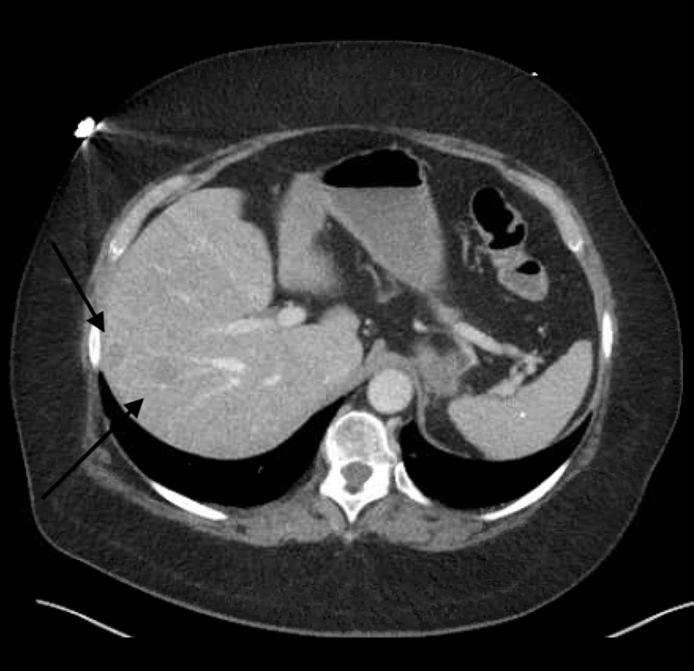 Contrast-enhanced CT imaging of the abdomen and pelvis revealing multiple hepatic lesions (arrows).