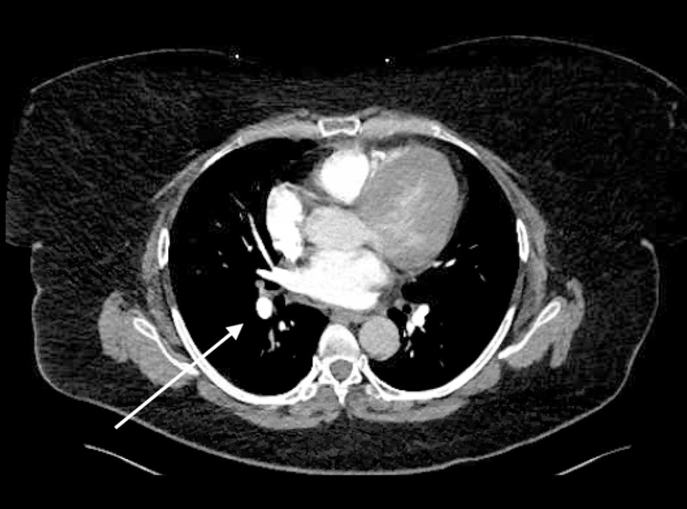 Contrast-enhanced computerized tomography angiography (CTA) of the chest revealing one of several pulmonary nodules (arrow).