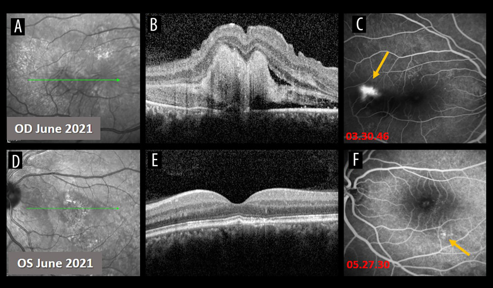 Follow-up visit in June 2021. (A) Infrared photo of the right eye (June 2021). (B) Corresponding optical coherence tomography (OCT) scan of the right eye. Temporally, a small amount of subretinal fluid (SRF) with a significant amount of subretinal fibrin-like material as well as folding of the inner retinal layers of the macula was observed (June 2021). (C) Fluorescein fundus angiography (FFA) of the right eye revealing a smokestack leakage temporally to the macula (yellow arrow) at 03.30.46. (June 2021). (D) Infrared photo of the left eye (June 2021). (E) Corresponding OCT scan of the left eye. A disruption of the RPE was noted, with no visible SRF (June 2021). (F) FFA of the left eye demonstrated 1 small staining point at the inferior macula (yellow arrow) at 05.27.30 (June 2021).