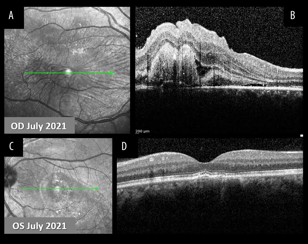 Follow-up of the patient in July 2021.(A) Infrared photo of the right eye in July 2021. (B) Corresponding optical coherence tomography (OCT) scan of the right eye revealed a small amount of SRF and a reduction of the fibrin-like material. Folding of the inner retinal layers at the macula was also observed (July 2021). (C) Infrared photo of the left eye in July 2021. (D) Corresponding OCT scan of the left eye remained stable, without subretinal fluid (SRF), with disruption of the RPE (July 2021).