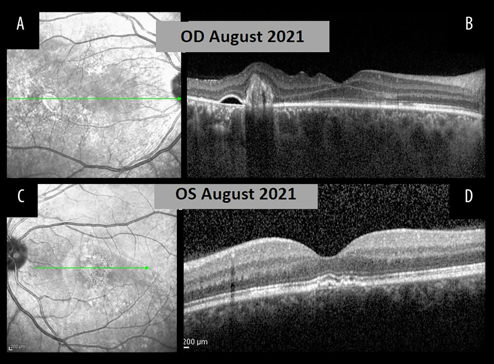 Follow-up visit in August 2021. (A) Infrared photo of the right eye in August 2021. (B) Corresponding optical coherence tomography (OCT) scan showed resolution of neurosensory detachment of the macula, a small pigment epithelial detachment (PED), and absorption of most of the fibrin-like material with residual material of the fovea remaining temporally (August 2021). (C) Infrared photo of the left eye in August 2021. (D) Corresponding OCT scan of the left eye. Note retinal pigment epithelium (RPE) abnormalities, without neurosensory retinal detachment (August 2021).
