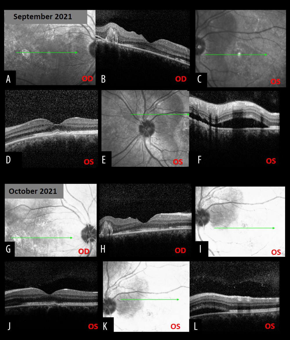 September 2021 and October 2021 follow-up visits. (A) Infrared photo of the right eye in September 2021. (B) Corresponding optical coherence tomography (OCT) scan showed resolution of neurosensory detachment of the macula, a shallower pigment epithelial detachment (PED), and absorption of most of the fibrin-like material, with residual material of the fovea remaining temporally (September 2021). (C) Infrared photo of the left eye in September 2021. Green arrow showing the scanning area at the macula. (D) Corresponding OCT scan of the left eye. Note retinal pigment epithelium (RPE) abnormalities, without neurosensory retinal detachment at the macula (September 2021). (E) Infrared photo of the left eye in September 2021. Green arrow showing the scanning area at a dark area superotemporal to the optic nerve. (F) Corresponding OCT scan of the left eye. Notice the subretinal fluid (SRF) at the place of the one of the 2 small staining points that was superotemporal to the optic nerve in May 2021 and disappeared in June 2021 (September 2021). (G) Infrared photo of the right eye in October 2021. (H) Corresponding optical coherence tomography (OCT) scan showed resolution of neurosensory detachment of the macula absorption of most of the fibrin-like material, with residual material of the fovea remaining temporally (October 2021). (I) Infrared photo of the left eye in October 2021. Green arrow showing the scanning area at the macula. (J) Corresponding OCT scan of the left eye. Note RPE abnormalities without neurosensory retinal detachment at the macula (October 2021). (K) Infrared photo of the left eye in October 2021. Green arrow showing the scanning area at a dark area superotemporal to the optic nerve. (L) Corresponding OCT scan of the left eye. The SRF located superotemporal to the optic nerve, at the area were one of the staining points of May 2021 was located, is shallower (October 2021).