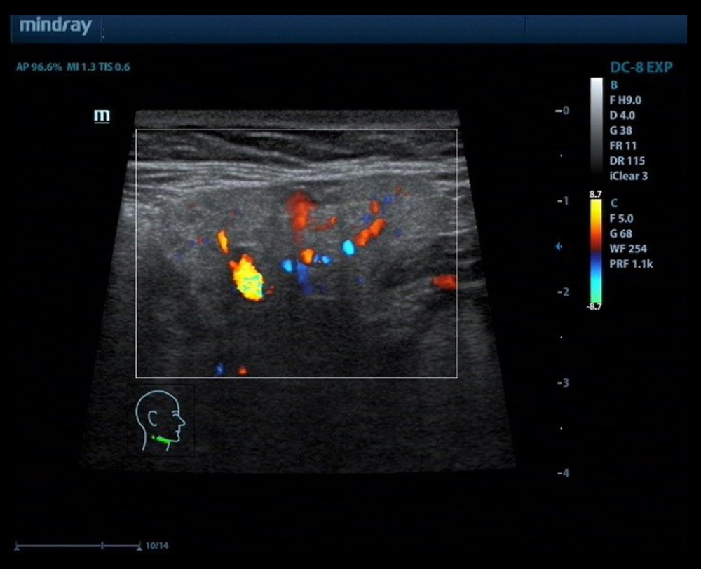 Ultrasound of the submandibular gland showed diffuse lesions.