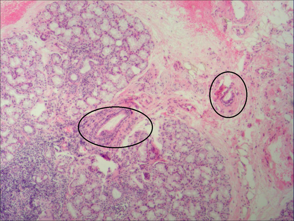 This biopsy of the labial gland showed a lesion with lymphocyte infiltration surrounding the gland duct.