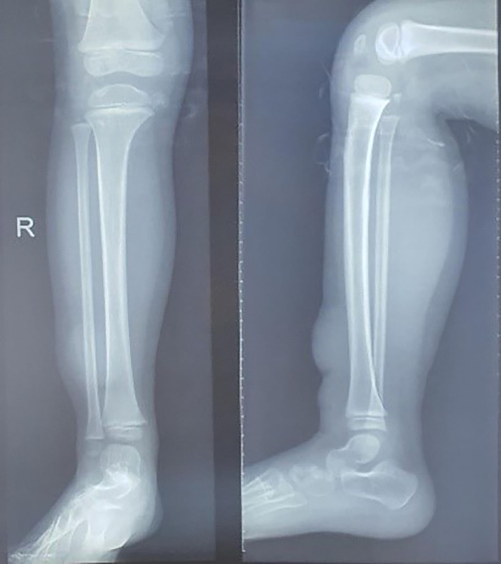 Plain radiography of the right cruris revealing a soft-tissue mass in the anterior side with no bone involvement.