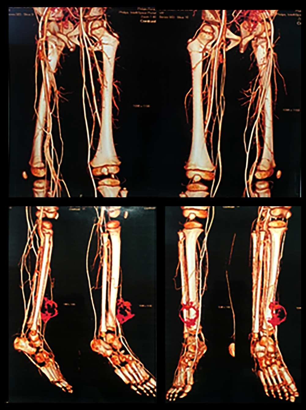 CT Angiography of the lower extremity showing a bulging soft-tissue mass.