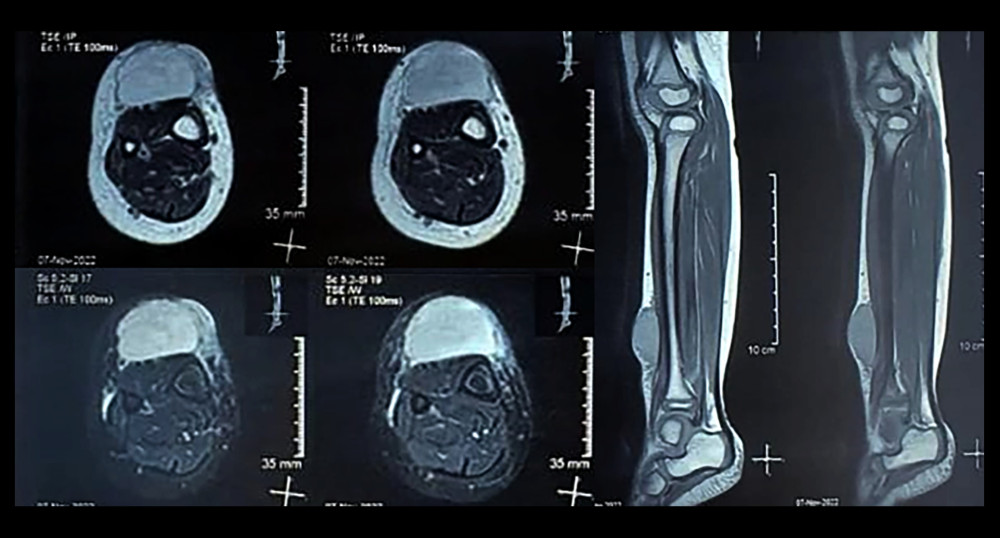 MRI right cruris. T1- and T2-weighted axial sagittal and view. MRI showing a suspected reactive lesion on the right cruris.