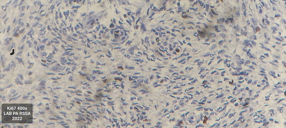 Histopathology: immunohistochemistry examination with Ki67 (400× magnification) showing a positive tumor cell nucleus.
