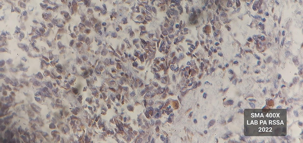 Histopathology: immunohistochemistry examination with SMA (400× magnification) showing focal-positive tumor cell cytoplasm.