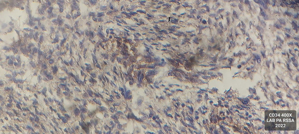 Histopathology: immunohistochemistry examination with CD34 (400× magnification) showing focal-positive tumor cell cytoplasm.