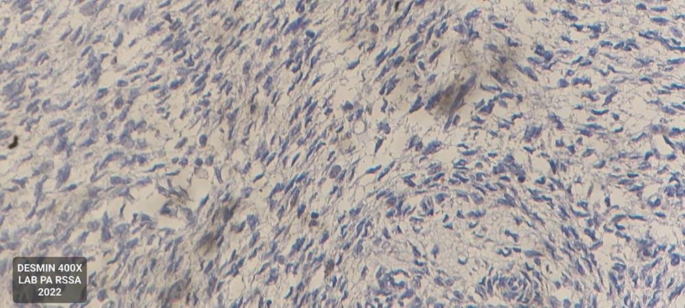 Histopathology: immunohistochemistry examination with desmin (400× magnification) showing a negative tumor cell.