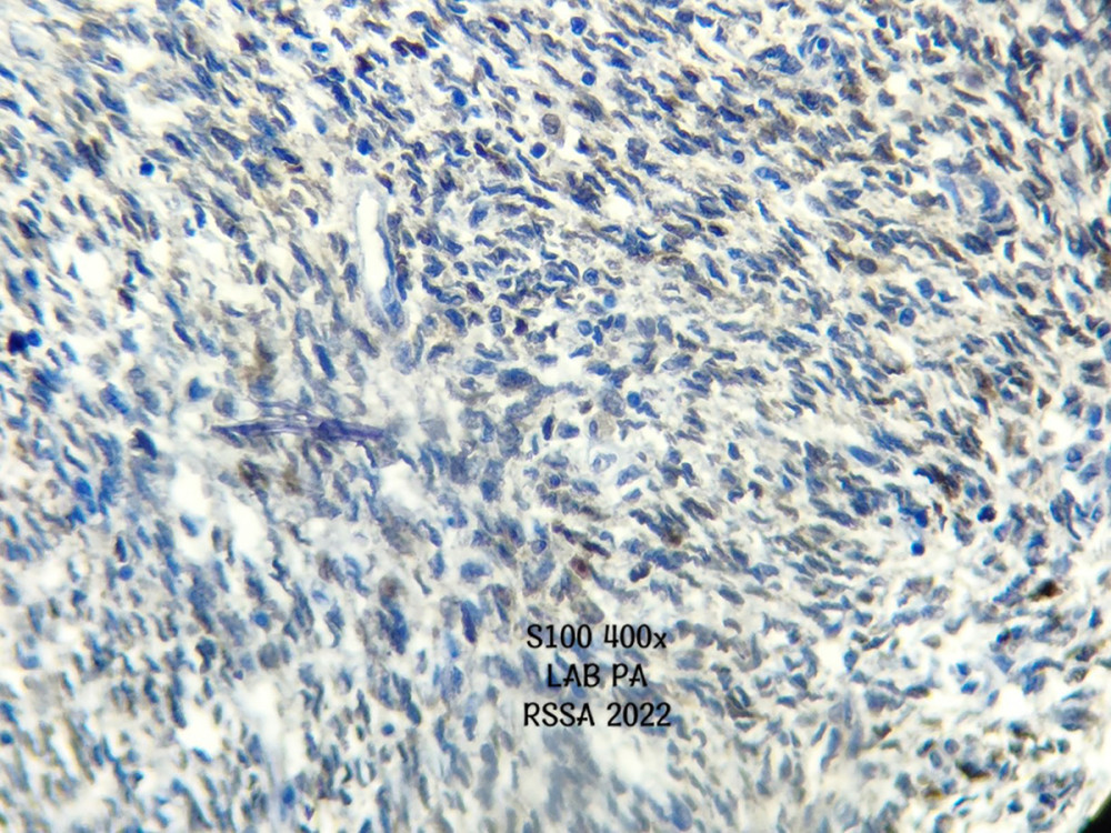 Histopathology: immunohistochemistry examination with S100 (400× magnification) showing a focal-positive tumor cell cytoplasm.
