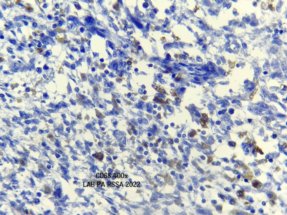 Histopathology: immunohistochemistry examination with CD68 (400× magnification) showing a histiocytic membrane cell between the tumor cell.