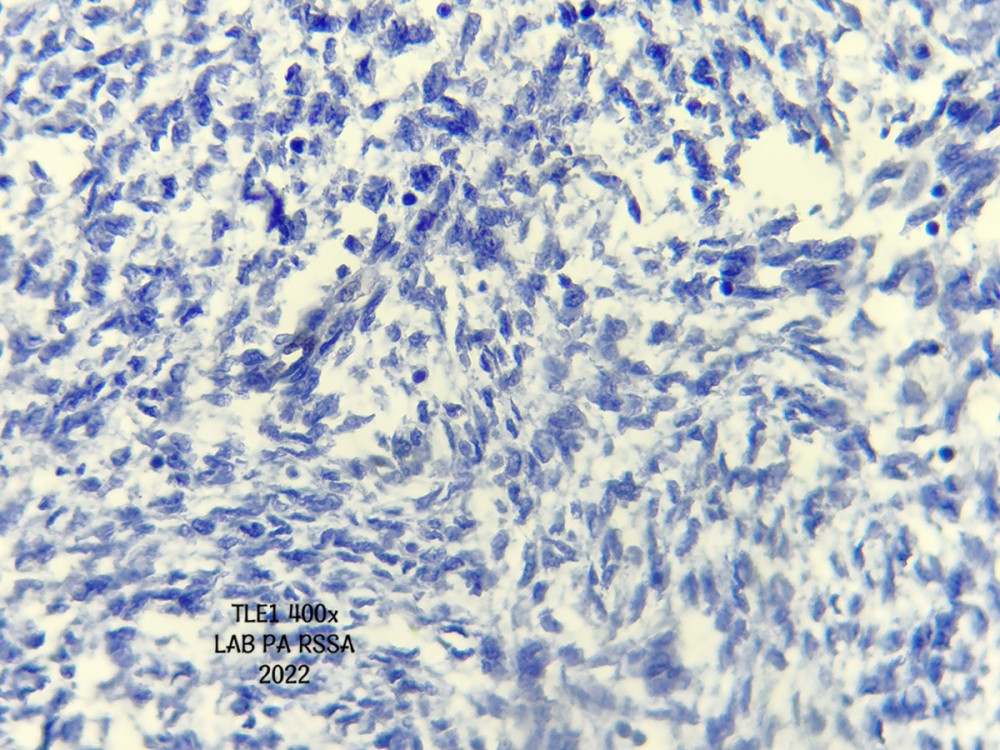 Histopathology: immunohistochemistry examination with TLE1 (400x magnification) showing a negative tumor cell.