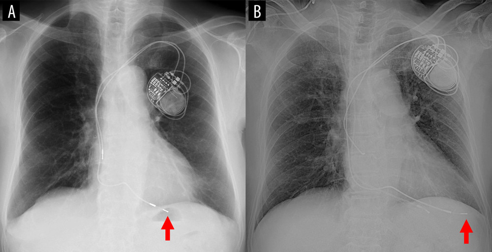 Chest radiography upon admission (A) and 2 months prior (B). The ventricular lead seems to have advanced forward (red arrows).