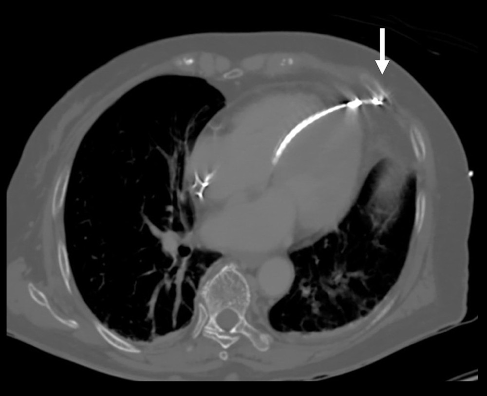 Computed tomography showing the RV pacing lead penetrated the RV apex and reached the left sixth rib (arrow). No pericardial effusion was detected. RV – right ventricle.