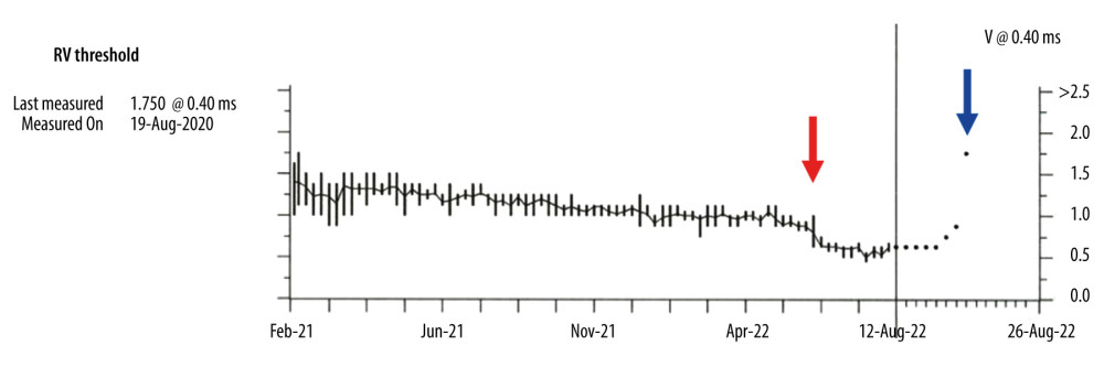 Device interrogation revealed a sudden increase (blue arrow) preceded by a gradual decrease (red arrow) in the RV pacing threshold, over the course of 2 months. RV – right ventricle.