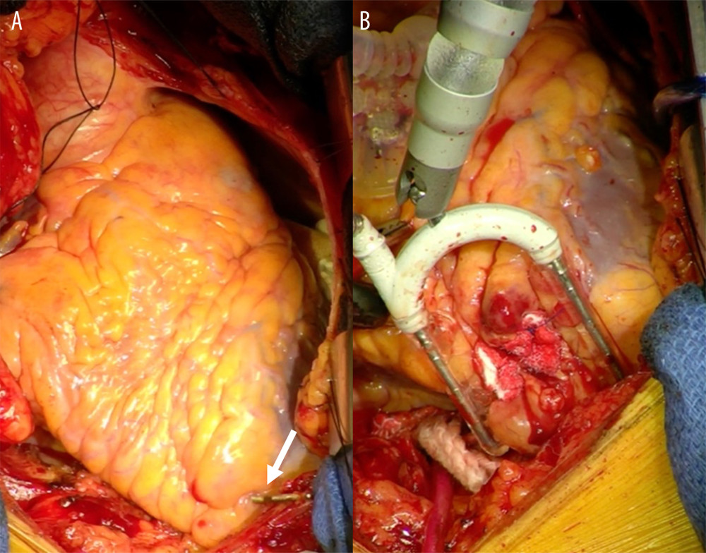 Intraoperative findings. (A) The RV lead protruded approximately 3 cm from the RV apex (arrow). (B) The perforated site was repaired using a 4-0 polypropylene thread with felt pledget.