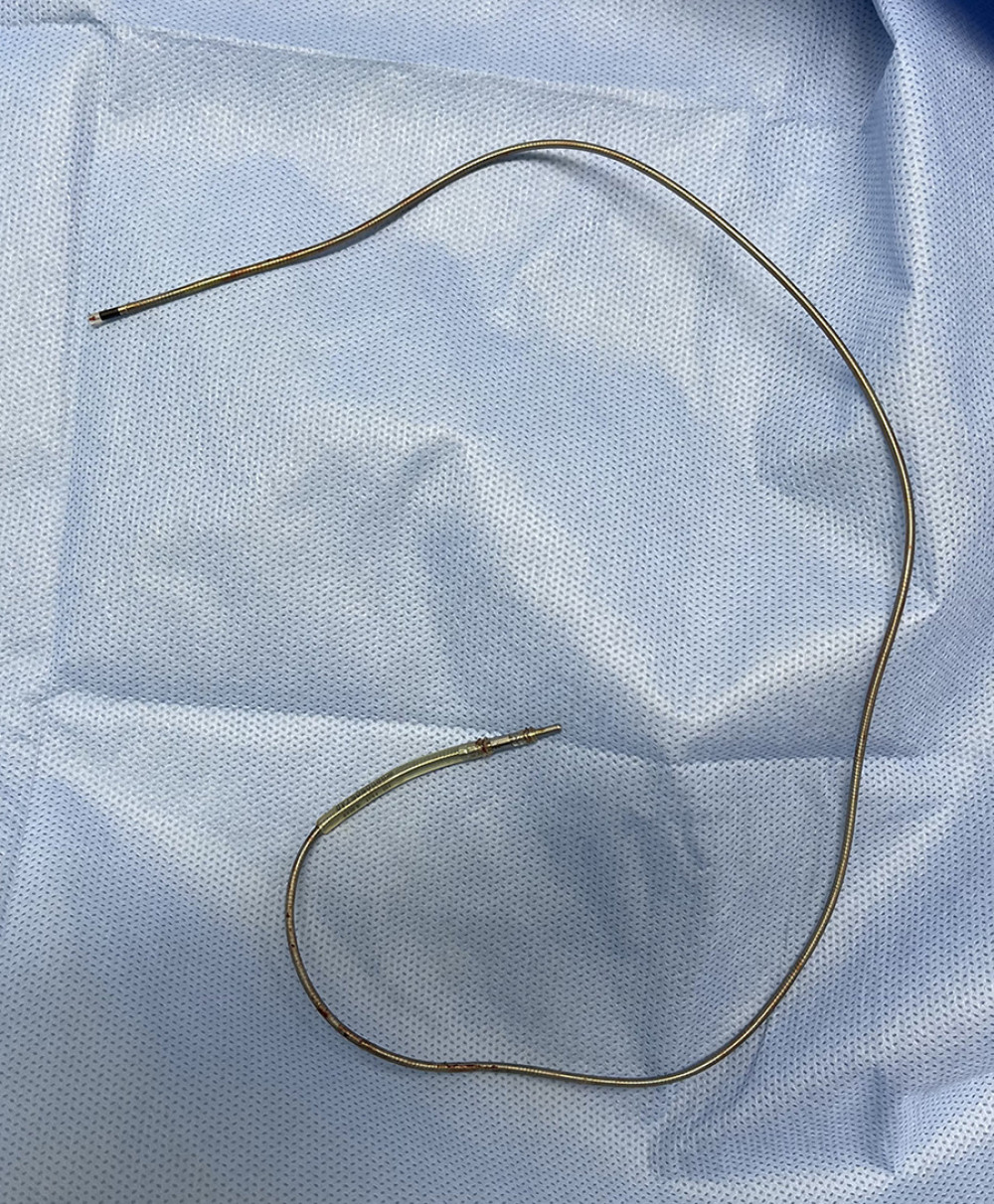 The removed ventricular lead. No thrombus or fibrous tissue adherence was identified.