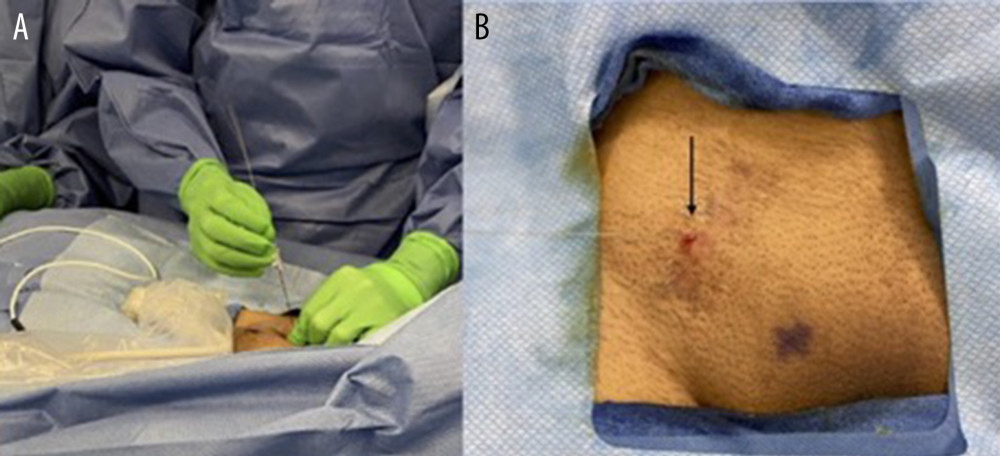 (A) Using ultrasound guidance, an arterial line marker was placed to mark the location of the genitofemoral nerve at the level of the right groin. (B) The skin entry site (black arrow) was consistent with the midpoint of the prior ECMO incision and the site of his Tinel’s sign on examination.
