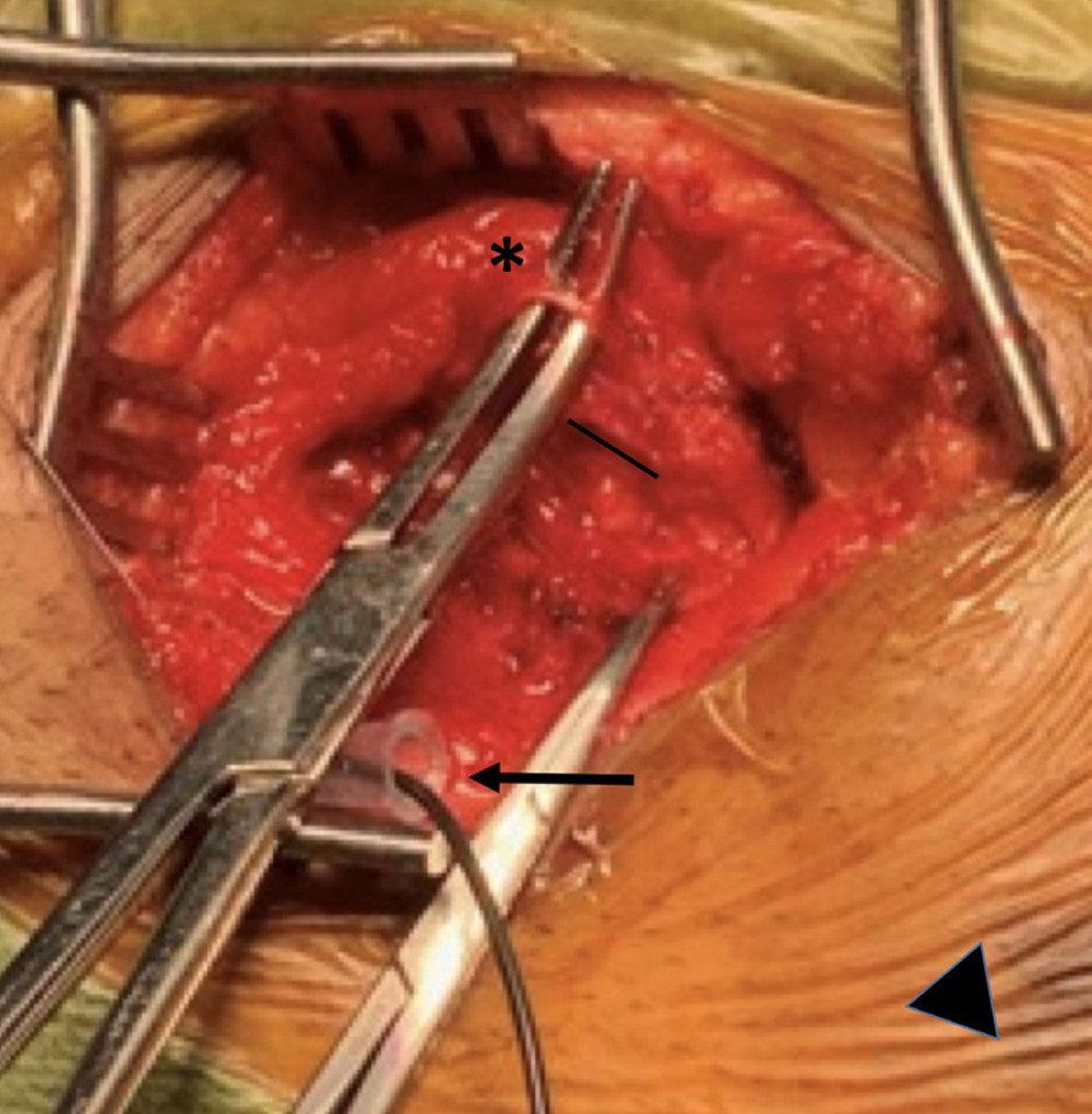 The right genital branch of the genitofemoral nerve is isolated and shown looped above forceps (*) following intraoperative nerve stimulation and observation of the cremasteric reflex. The nerve was identified overlying the spermatic cord (a solid black line is shown parallel to its location). A ground electrode is shown under the body of the forceps (black arrow). The right scrotum, which is not included in this intraoperative photo, was located just beyond the solid arrowhead at the inferior and medial aspect of the surgical field.