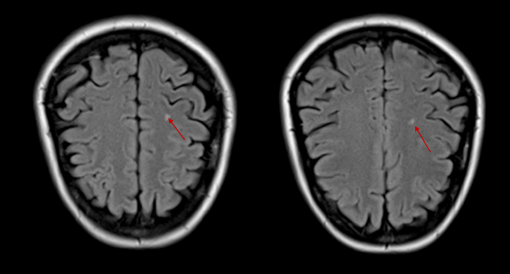 Magnetic resonance imaging of the brain showing two 6×2-mm ischemic infarcts in the right posterior centrum semiovale.