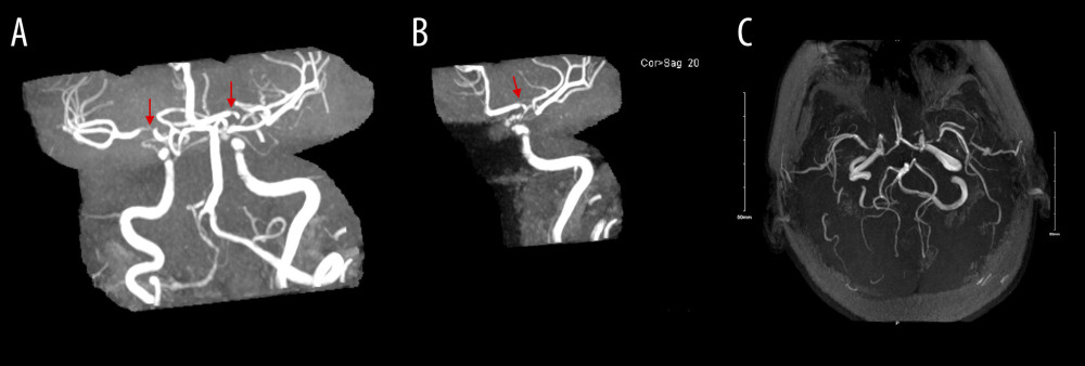 Magnetic resonance angiography of the head illustrating (A) high-grade stenosis of the bilateral cavernous carotid arteries, (B) supraclinoid carotid arteries, and proximal segments of the middle cerebral artery; (C) several bundles of smaller collateral arteries can be seen.