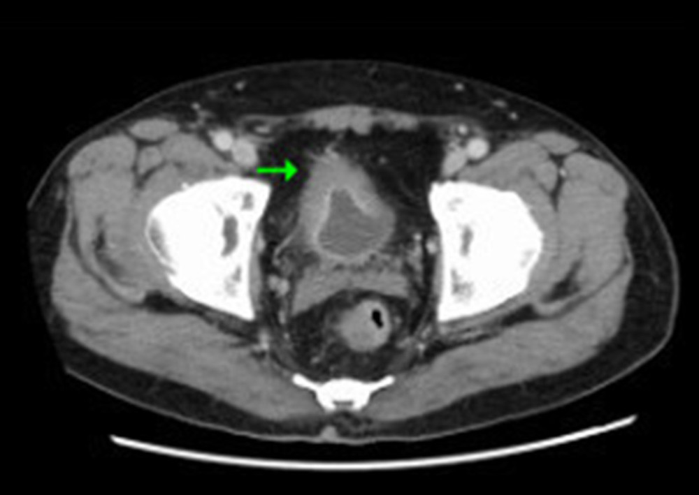 Computed tomography scan of bladder with contrast. Detailed explanation: The bladder wall is significantly thickened as indicated by the arrow.
