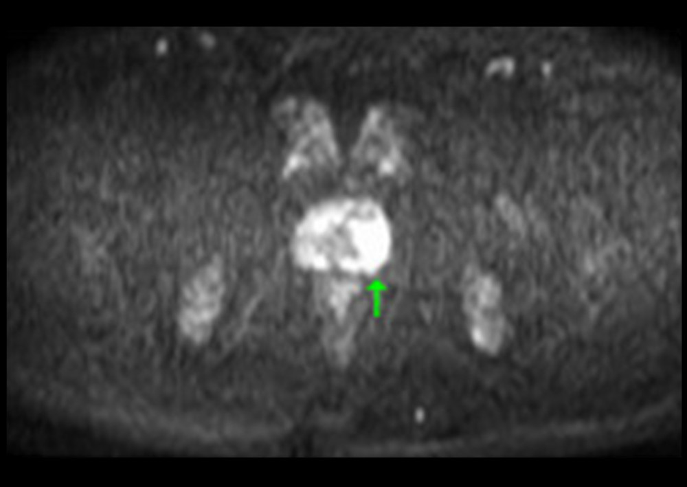 Magnetic resonance imaging of the prostate without contrast (diffusion-weighted image).