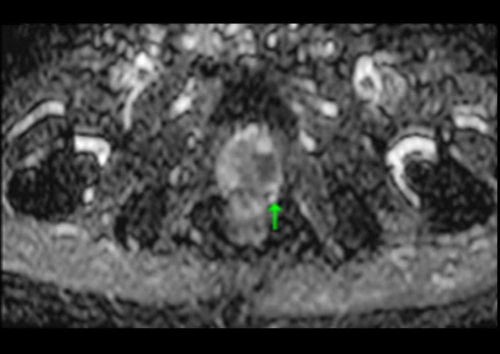 Magnetic resonance imaging of the prostate without contrast (apparent diffusion coefficient mapping).
