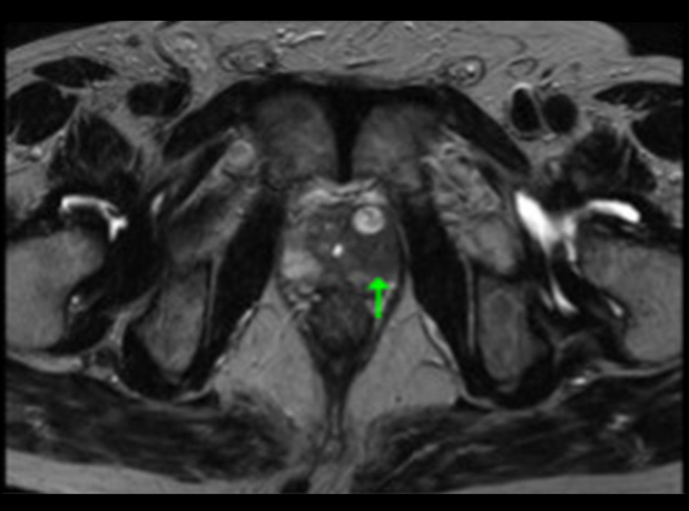 Magnetic resonance imaging of the prostate without contrast (T2-weighted image). Detailed explanation of Figures 2–4: A diffusion-weighted image shows a high signal and apparent diffusion coefficient mapping shows a diffusion-limited lesion centered in the limbic region of the right lobe of the prostate. The same area shows a low signal on T2-weighted images, which indicates a granulomatous lesion, as indicated by the arrows.