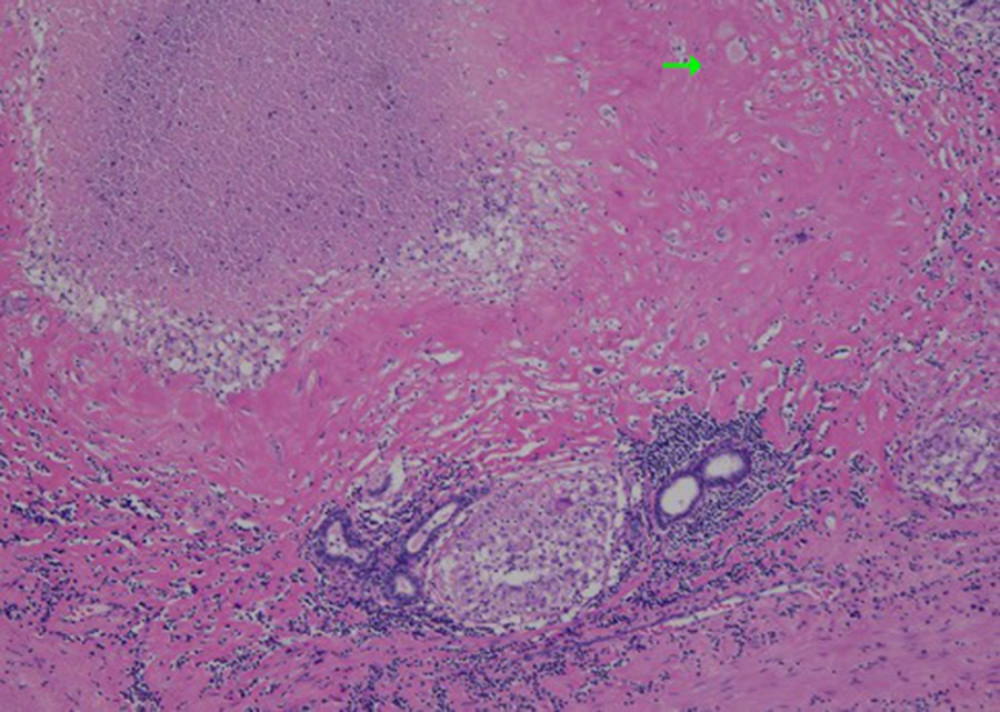 Histological findings of the prostate (H&E stain). Detailed explanation: There is epithelioid granuloma with Langhans giant cells, as indicated by the arrow.