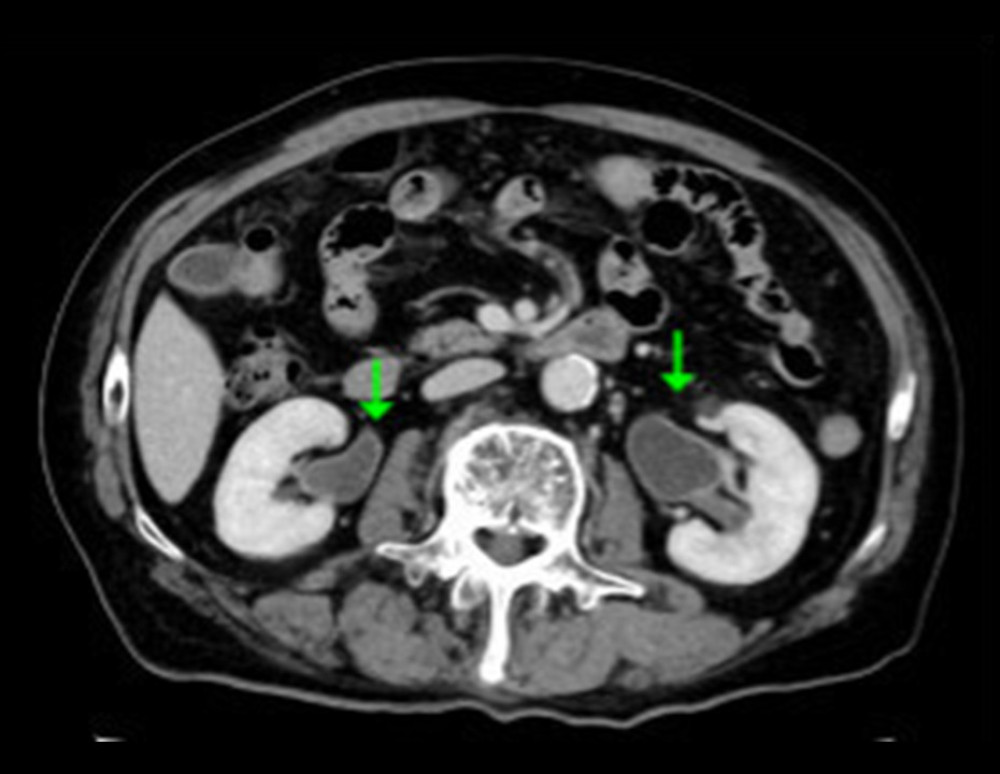Computed tomography scan of the abdomen with contrast. Detailed explanation: There is a thickening of the ureter as indicated by the arrows.