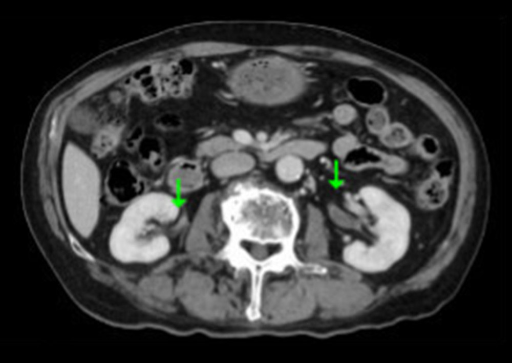 Computed tomography scan of abdomen with contrast. Detailed explanation: The thickening of the ureter is improving, as indicated by the arrows.