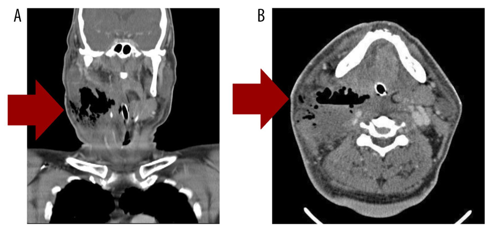 Computed tomography (CT) scan of neck; (A) Coronal view (B) Axial view; CT scan showed the presence of gas involving all cervical spaces: the loculated collection with internal emphysema, 12.6×8.7×6.8 cm from right masticator space, right parotid space, right paralaryngeal space, with swelling of right para- and retropharyngeal soft tissue. The red arrows point to the area of the gas-forming abscess.