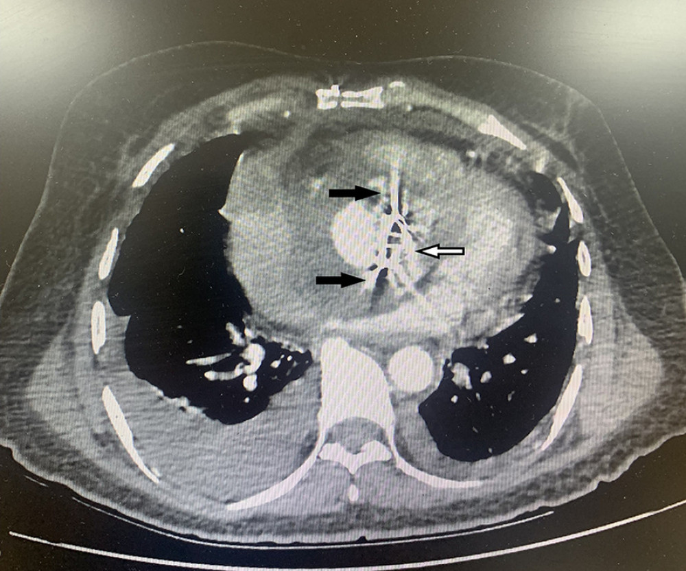 Computed tomography aortogram showing paravalvular leakage of the contrast material from the aortic root (black arrows), and mechanical prosthesis in situ (white arrow).