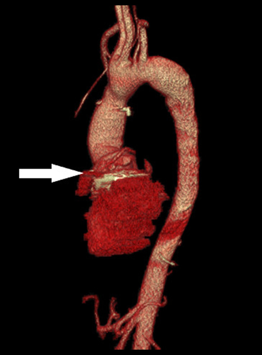 Volume-rendering technique of computed tomography showing previous Bentall’s valve-graft prosthesis (arrow), and the entire aorta.