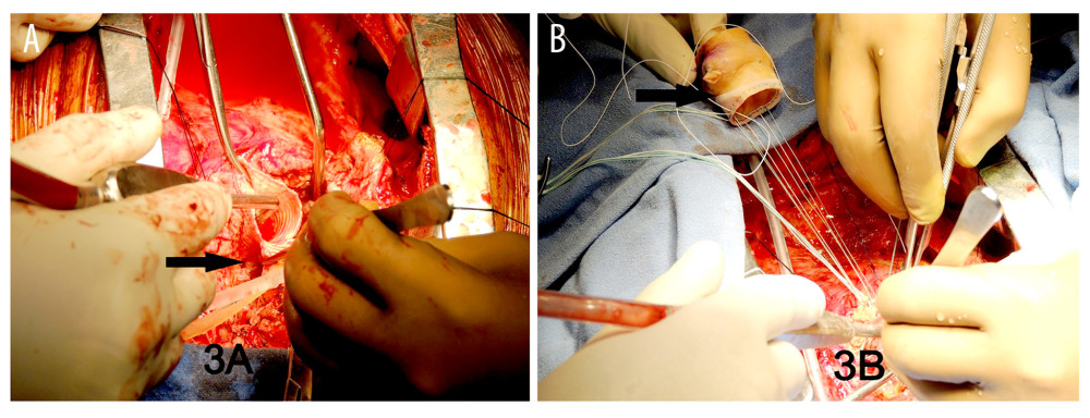 Surgical photographs showing para-aortic abscess (A), and porcine root being sutured to the neo-annulus (B).