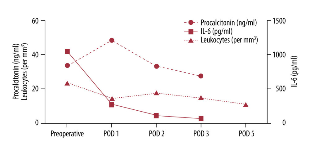 Perioperative course of inflammatory markers: interleukin-6, leucocytes, and procalcitonin.