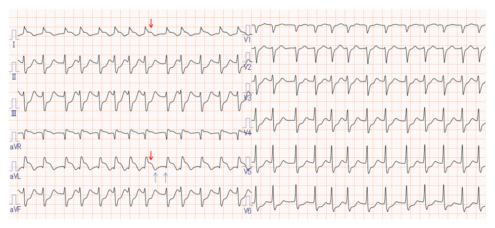 Electrocardiogram on admission, showing ST elevation in the I and aVL leads (red arrows) and small Q waves and negative T waves in the aVL lead (blue arrow).